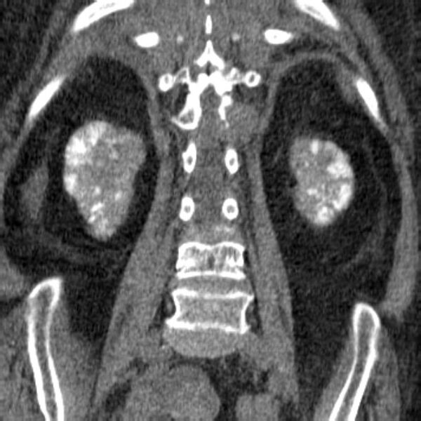 File:Acute tubular necrosis (Radiopaedia 28077-28334 Coronal non-contrast 26).jpg