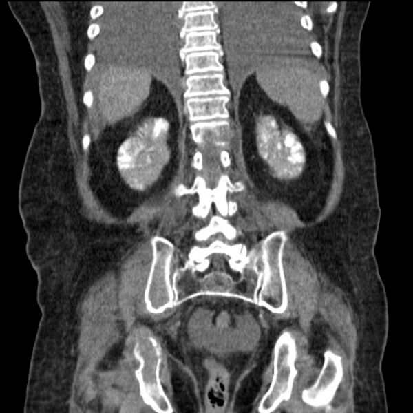 File:Acute tubular necrosis (Radiopaedia 28077-28334 D 63).jpg