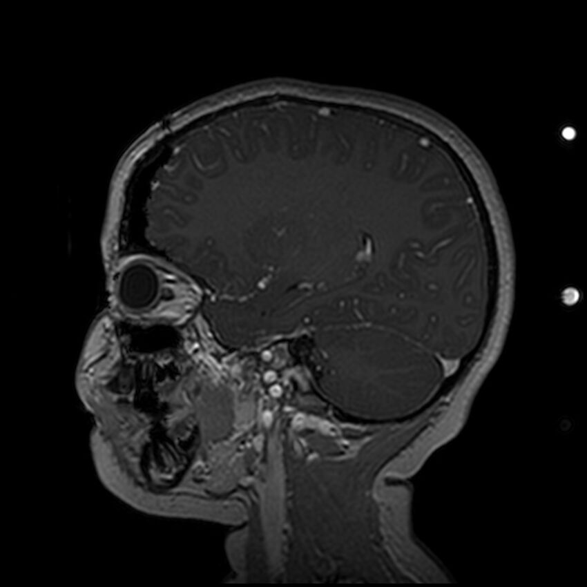 Adamantinomatous craniopharyngioma (Radiopaedia 77407-89529 H 42).jpg