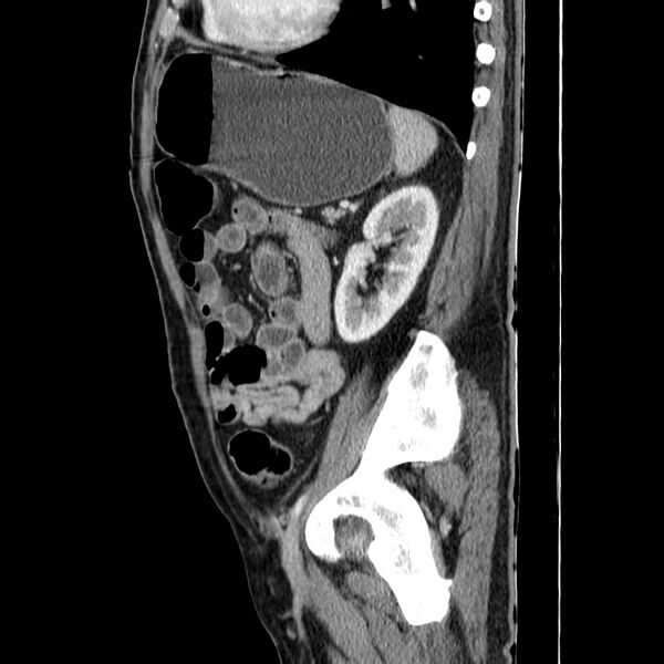 File:Adenocarcinoma of colon with entero-colic fistula (Radiopaedia 22832-22852 Sagittal C+ portal venous phase 46).jpg