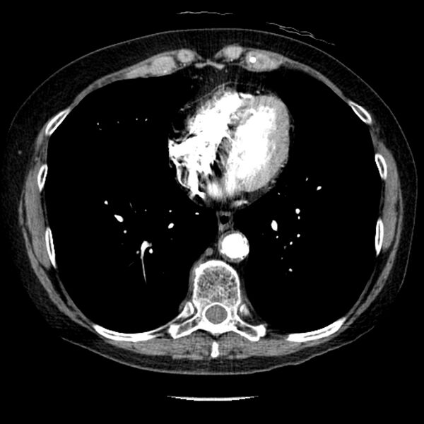 File:Adenocarcinoma of the lung (Radiopaedia 41015-43755 Axial C+ portal venous phase 83).jpg