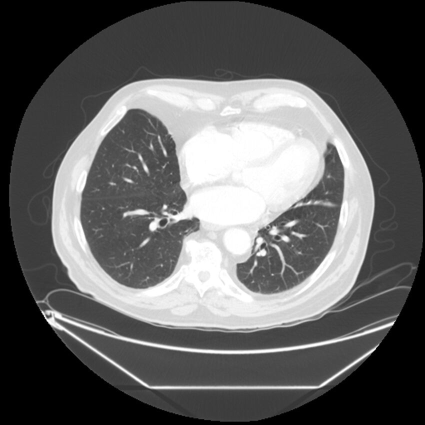 Adenocarcinoma of the lung (Radiopaedia 44876-48759 Axial lung window 52).jpg