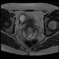 Adenoma malignum of the cervix (Radiopaedia 24460-24765 C 14).jpg