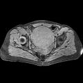 Adenomyoma of the uterus (huge) (Radiopaedia 9870-10438 Axial T1 fat sat 13).jpg