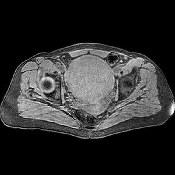 File:Adenomyoma of the uterus (huge) (Radiopaedia 9870-10438 Axial T1 fat sat 13).jpg