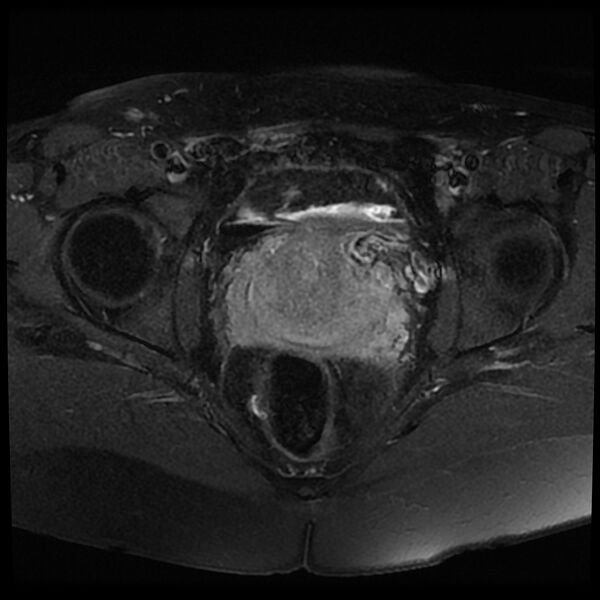 File:Adenomyosis-scar endometriosis (Radiopaedia 65863-75022 Axial T1 C+ fat sat 17).jpg