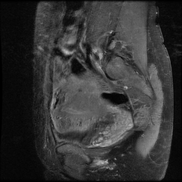 File:Adenomyosis on MRI (Radiopaedia 29328-29780 Sagittal T1 C+ fat sat 13).jpg
