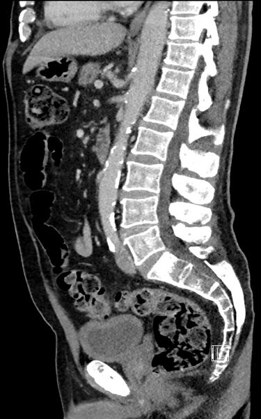 File:Adrenal lymphoma (Radiopaedia 73730-84529 Sagittal C+ portal venous phase 61).jpg