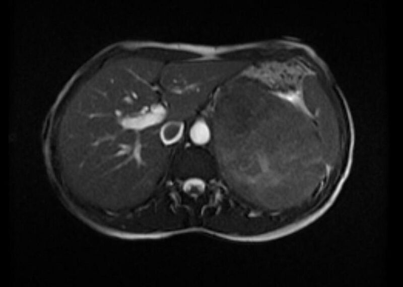 File:Adrenocortical carcinoma (Radiopaedia 11176-11541 Axial 2).jpg