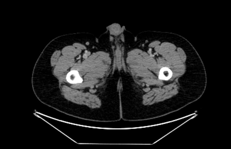 File:Adrenocortical carcinoma (Radiopaedia 80134-93438 Axial C+ portal venous phase 147).jpg