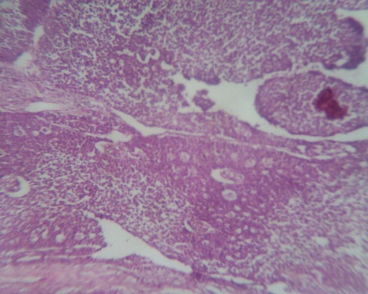 File:Adult granulosa cell tumor of the ovary (Radiopaedia 64991-74394 E 1).jpg
