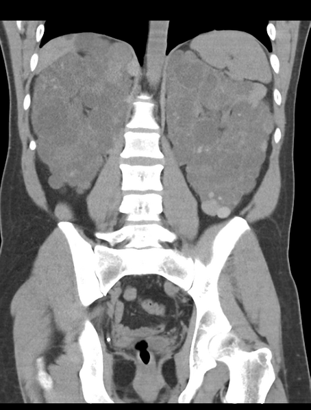 File:Adult polycystic kidney disease (Radiopaedia 47866-52626 Coronal non-contrast 33).png