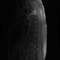 Aggressive vertebral hemangioma (Radiopaedia 39937-42404 B 9).png