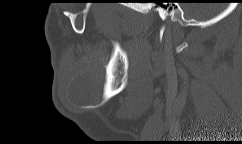 File:Ameloblastoma (Radiopaedia 33677-34806 Sagittal bone window 20).png