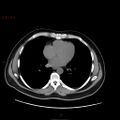 Ampullary carcinoma (Radiopaedia 56396-63056 Axial non-contrast 1).jpg