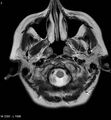 Amyotrophic lateral sclerosis (Radiopaedia 5373-7134 Axial T2 3).jpg