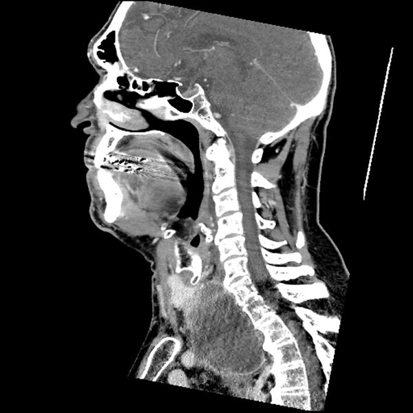 File:Anaplastic thyroid carcinoma (Radiopaedia 79087-92034 C 47).jpg