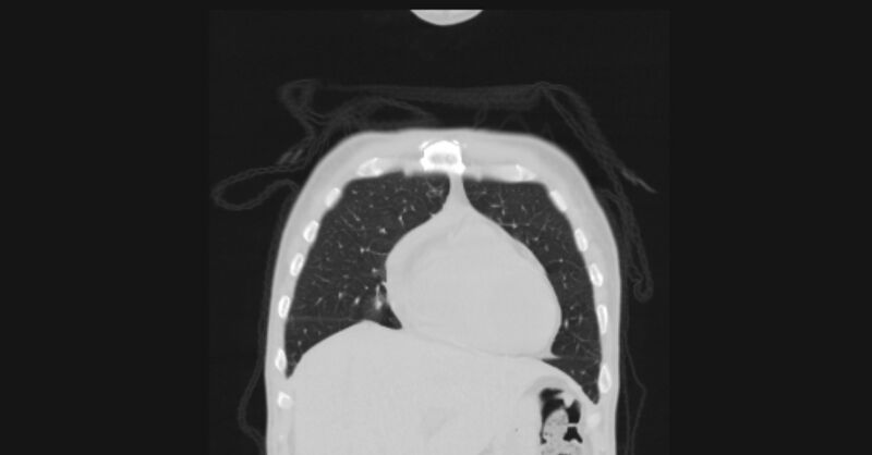 File:Angioinvasive aspergellosis (Radiopaedia 66995-76315 Coronal lung window 11).jpg