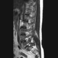 Ankylosing spondylitis with zygapophyseal arthritis (Radiopaedia 38433-40516 Sagittal T2 9).jpg