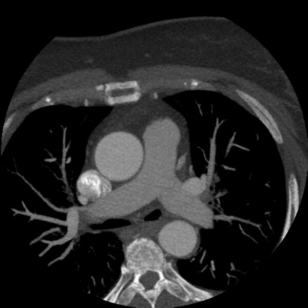 File:Anomalous origin of left circumflex artery from right coronary sinus (Radiopaedia 72563-83117 A 53).jpg
