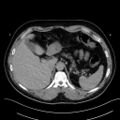 Anomalous origin of the left coronary artery with malignant course (Radiopaedia 77842-90126 Axial non-contrast 34).jpeg
