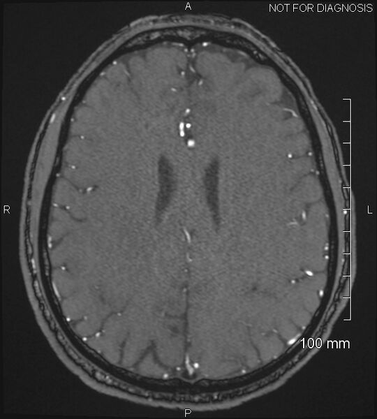 File:Anterior cerebral artery aneurysm (Radiopaedia 80683-94127 Axial MRA 167).jpg