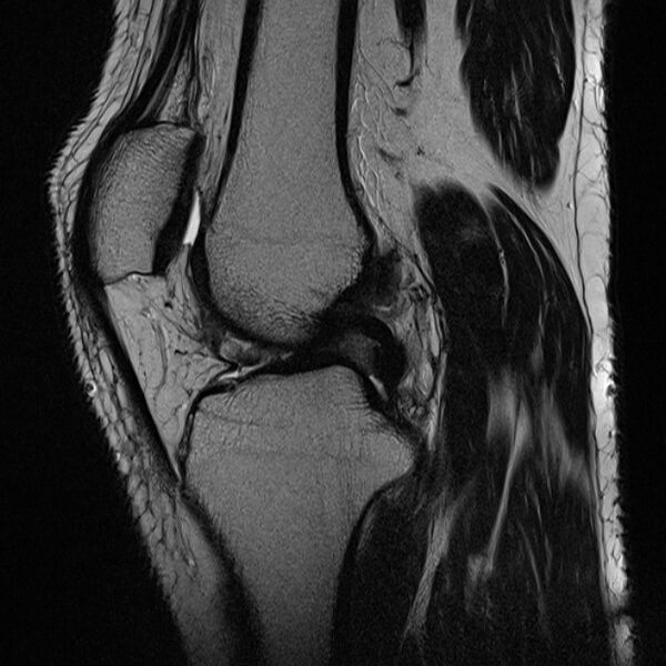 File:Anterior cruciate ligament tear - ramp lesion (Radiopaedia 71883-82322 Sagittal T2 14).jpg