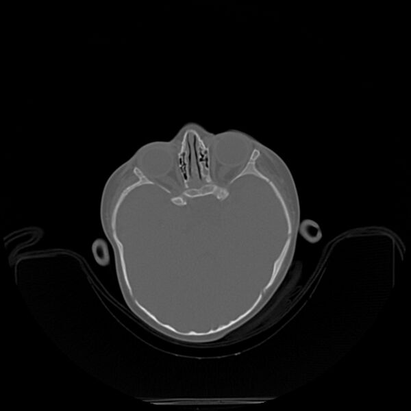 File:Anterior plagiocephaly (Radiopaedia 71836-82273 C 7).jpg