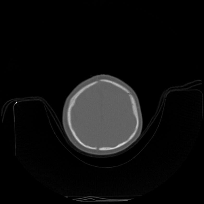 Anterior plagiocephaly (Radiopaedia 71836-82273 C 88).jpg