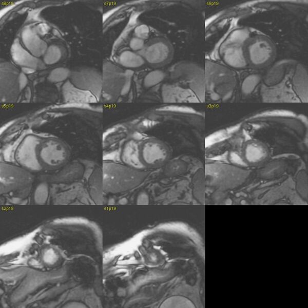 File:Anteroseptal hypokinesia after myocardial infarction (Radiopaedia 15978-15633 E 13).jpg