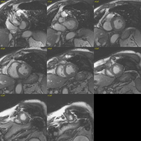 File:Anteroseptal hypokinesia after myocardial infarction (Radiopaedia 15978-15633 E 26).jpg