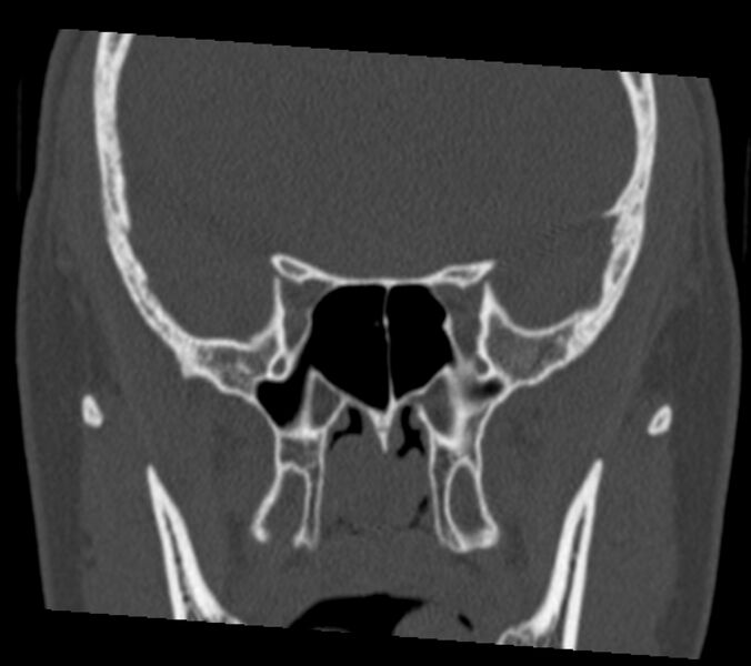 File:Antrochoanal polyp (Radiopaedia 21894-21868 Coronal bone window 24).jpg