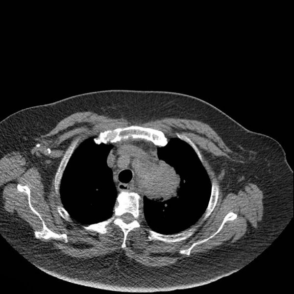 File:Aortic arch false aneurysm (Radiopaedia 14667-14587 Axial non-contrast 3).jpg