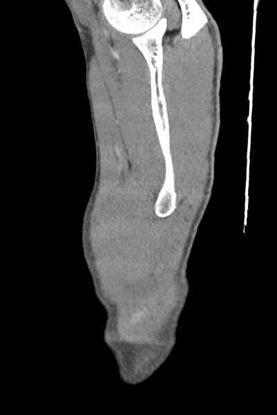 File:Aortic coarctation with aneurysm (Radiopaedia 74818-85828 B 11).jpg