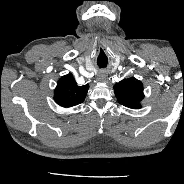 File:Aortic dissection - DeBakey Type I-Stanford A (Radiopaedia 79863-93115 A 1).jpg