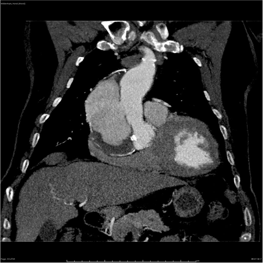 Aortic dissection - Stanford type A (Radiopaedia 26183-26315 A 14).jpg