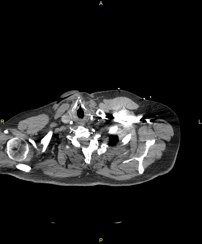 Aortic rupture (Radiopaedia 88822-105594 B 7).jpg