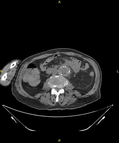 File:Aortoenteric fistula (Radiopaedia 84308-99603 Axial non-contrast 197).jpg