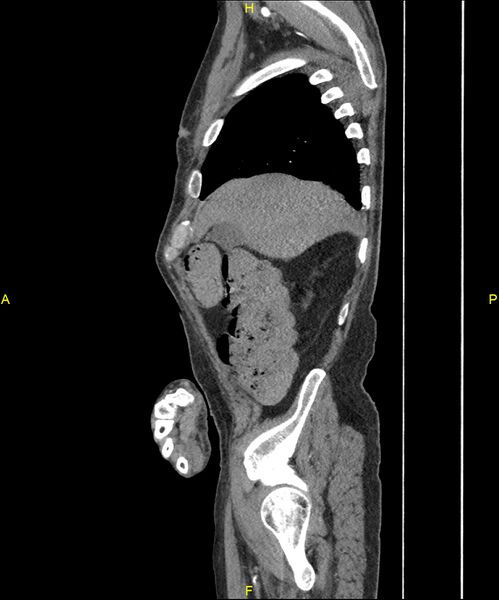 File:Aortoenteric fistula (Radiopaedia 84308-99603 C 63).jpg