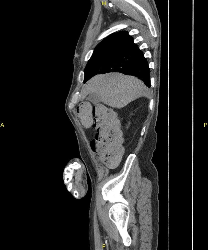 Aortoenteric fistula (Radiopaedia 84308-99603 C 63).jpg