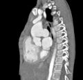 Aortopulmonary window, interrupted aortic arch and large PDA giving the descending aorta (Radiopaedia 35573-37074 C 19).jpg