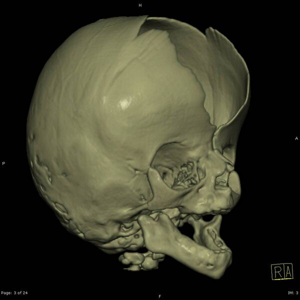 File:Apert syndrome with syndactyly (Radiopaedia 10315-10834 3D MPR bone window 3).jpg