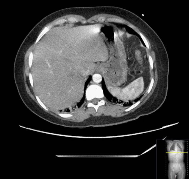 File:Appendicitis (CT angiogram) (Radiopaedia 154713-127660 Axial 166).jpg