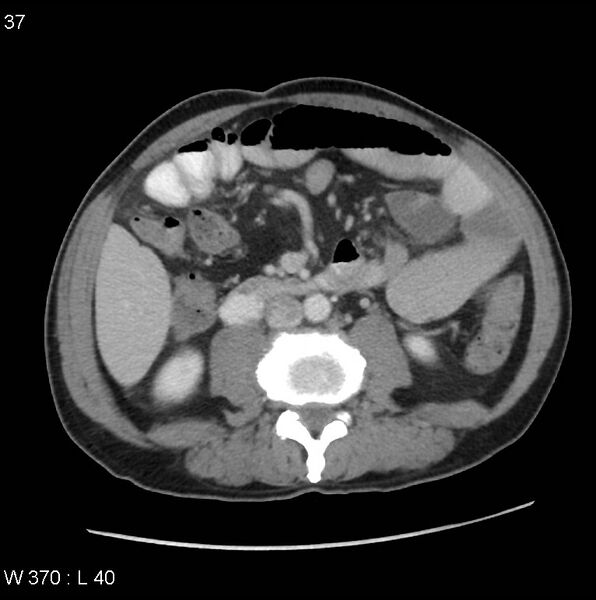 File:Appendicitis (Radiopaedia 27446-27642 A 16).jpg
