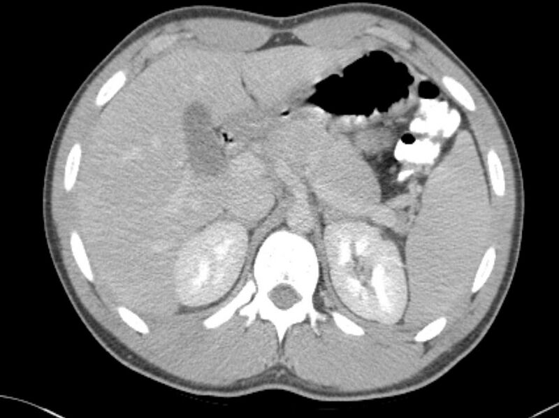 File:Appendicitis and incidental foregut duplication cyst (Radiopaedia 52962-58916 A 1).jpg
