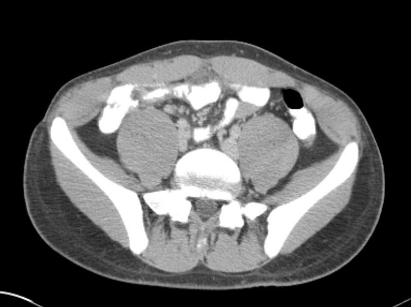File:Appendicitis and incidental foregut duplication cyst (Radiopaedia 52962-58916 A 62).jpg
