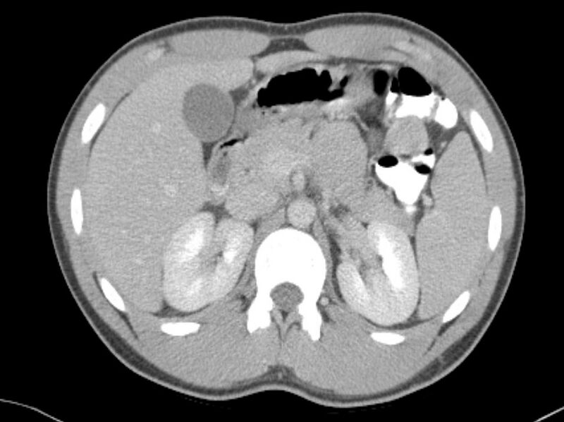 File:Appendicitis and incidental foregut duplication cyst (Radiopaedia 52962-58916 A 8).jpg