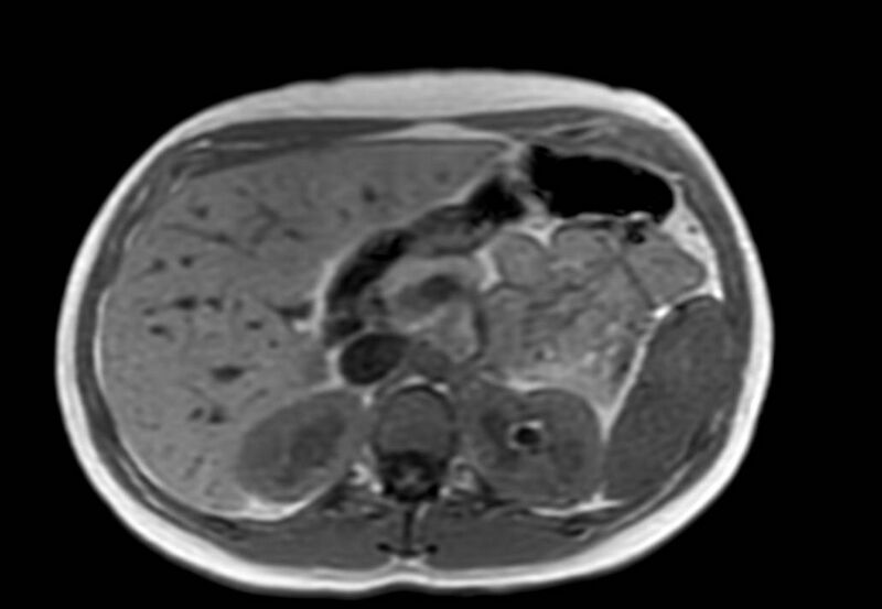 File:Appendicitis in gravida (MRI) (Radiopaedia 89433-106395 Axial T1 in-phase 17).jpg
