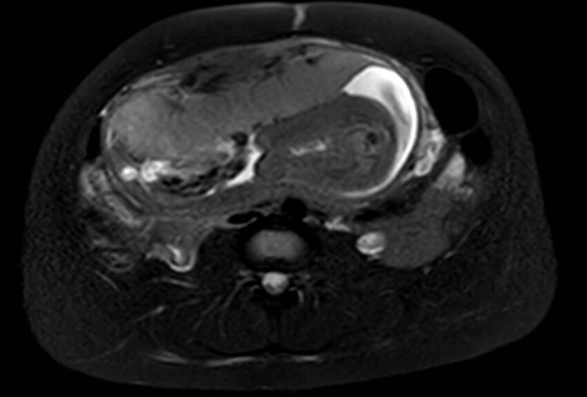 Appendicitis in gravida (MRI) (Radiopaedia 89433-106395 Axial T2 SPAIR 42).jpg