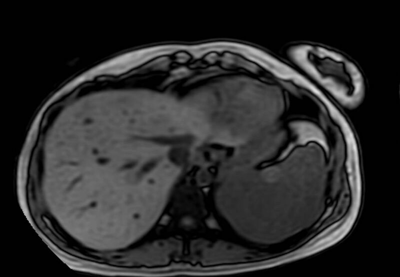 File:Appendicitis in gravida (MRI) (Radiopaedia 89433-106395 D 4).jpg